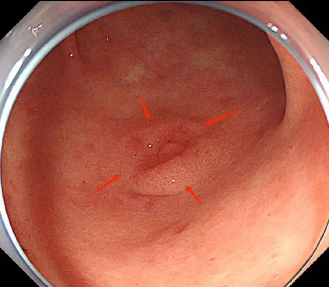 胃镜下早期胃癌图片图片