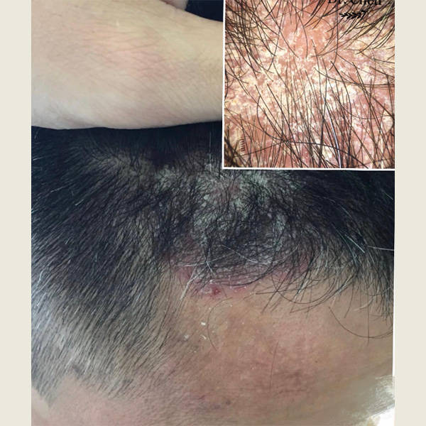 哪款洗发水含有二硫化硒?_头皮屑_问题_头发