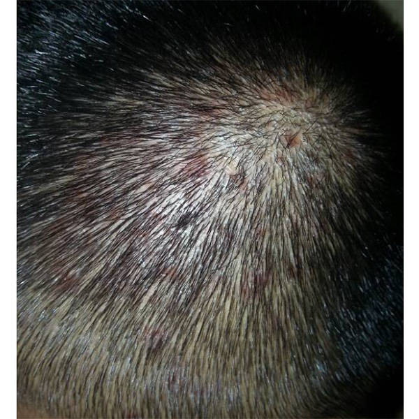 酵母感染:头皮上的酵母菌,尤其是马拉色亚菌,可能过度繁殖,导致头皮屑