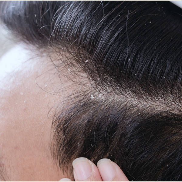 头皮屑_头发_孩子