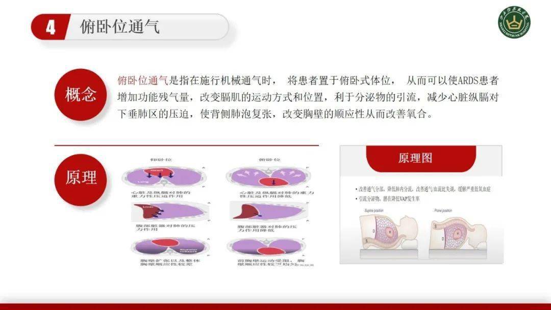 俯卧位通气原理图片图片