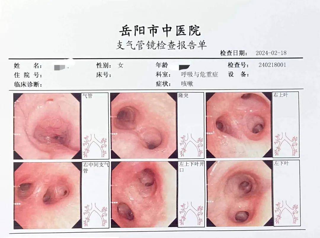 呼吸与危重症医学科杨辉红主任通过支气管镜及镜下治疗,深入清理气道