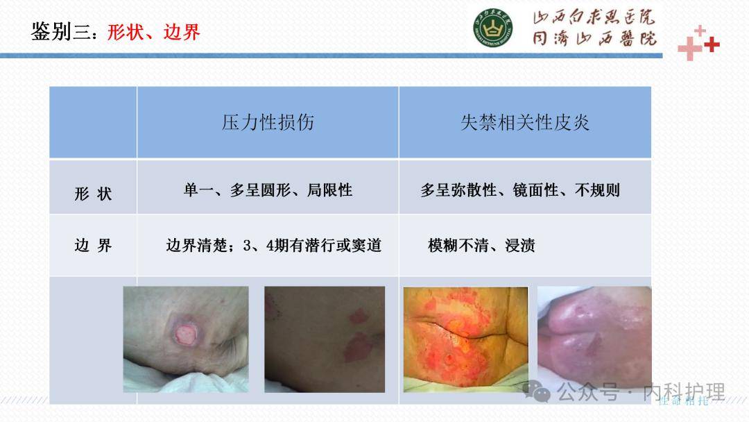 【ppt】成人失禁相关性皮炎的识别与护理