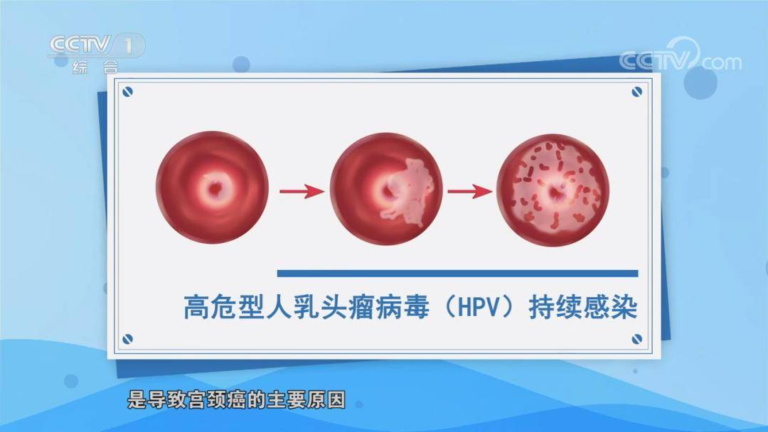 打了hpv疫苗3年后患宫颈癌出现这些症状千万别大意丨国际hpv知晓日