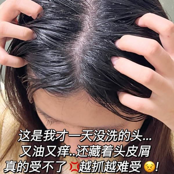 毛囊受损用什么洗发水?_头皮_去屑_头发