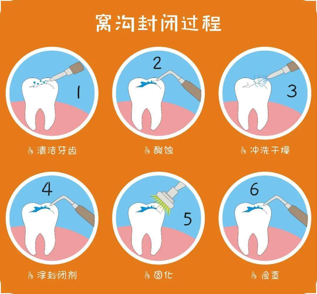 守护微笑的起点给乳牙打个预防针窝沟封闭