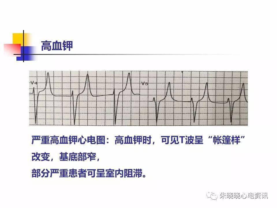 ppt危急值心电图详解