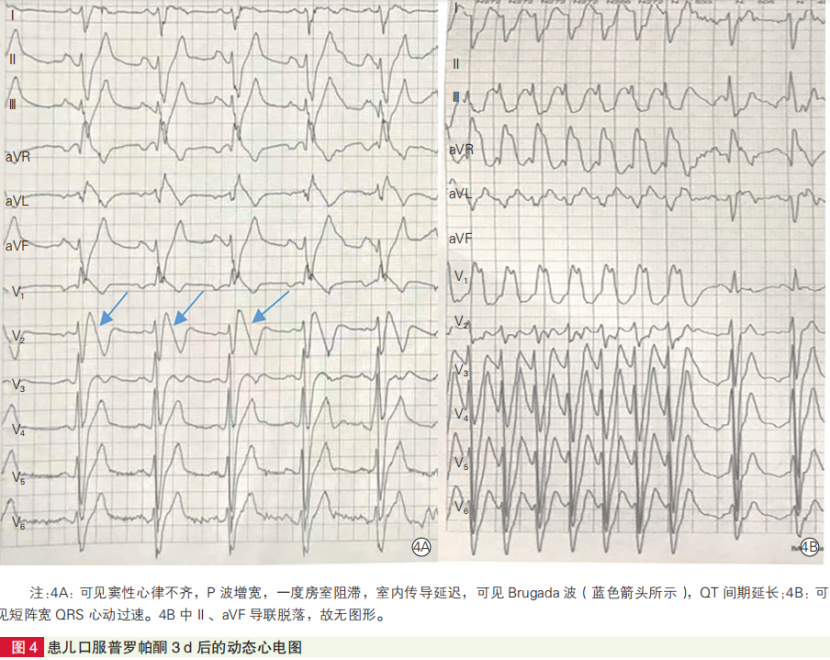 病例报告普罗帕酮诱发儿童brugada样心电图改变吉大一院学者报告