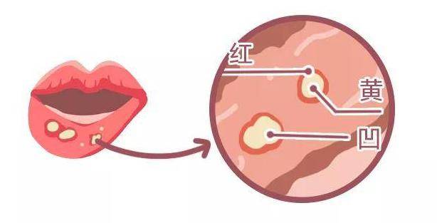 口腔血管神经性水肿图片