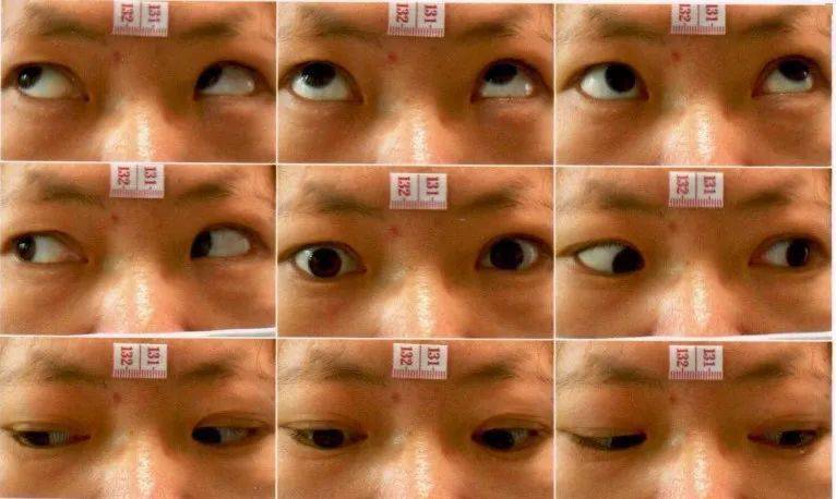 复视斜视为何因?眼肌麻痹,针灸效佳_治疗_眼球_运动