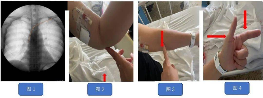 一例picc置管致手指麻木的原因分析