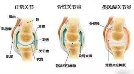 金小鸥讲健康风湿免疫疾病系列类风湿性关节炎