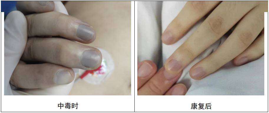 提醒这些日常食物可能潜藏亚硝酸盐中毒风险