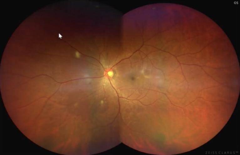 超广角眼底照相机拍摄技巧超实用