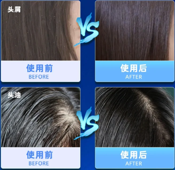 二硫化硒洗剂用前可以用洗发水吗?_头皮_问题_产品