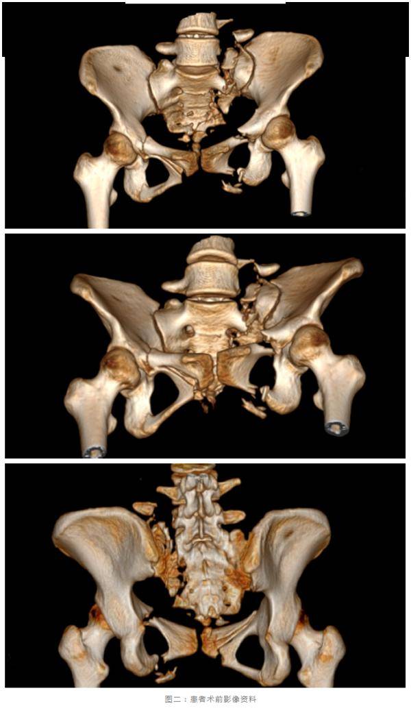 融智于术|烟台山医院成功完成山东首例智能化骨盆复位机器人微创治疗