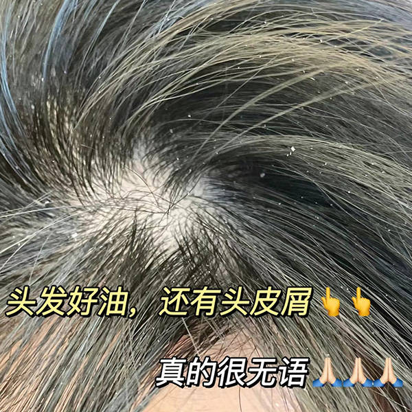 什么牌子的洗发水去头屑比较好?