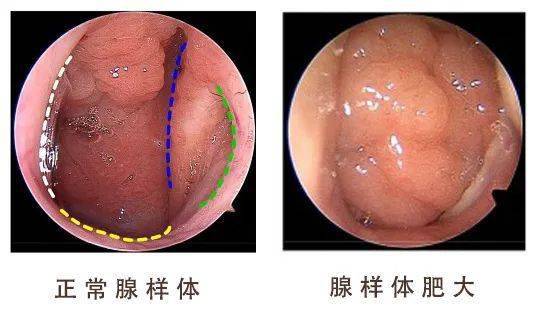 医生常常根据腺样体阻塞鼻后孔的程度