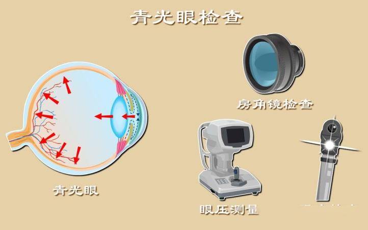 健康科普你了解青光眼吗