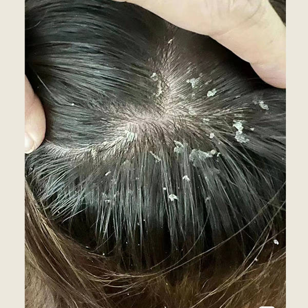 头痒用什么洗头可以止痒