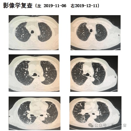 肺痹病中医病证特点发病急,或亚急性起病,病程较短实证为主体,多表现