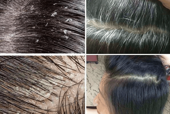 9岁儿童有头皮屑用什么洗发水好??_头发_去屑_成分