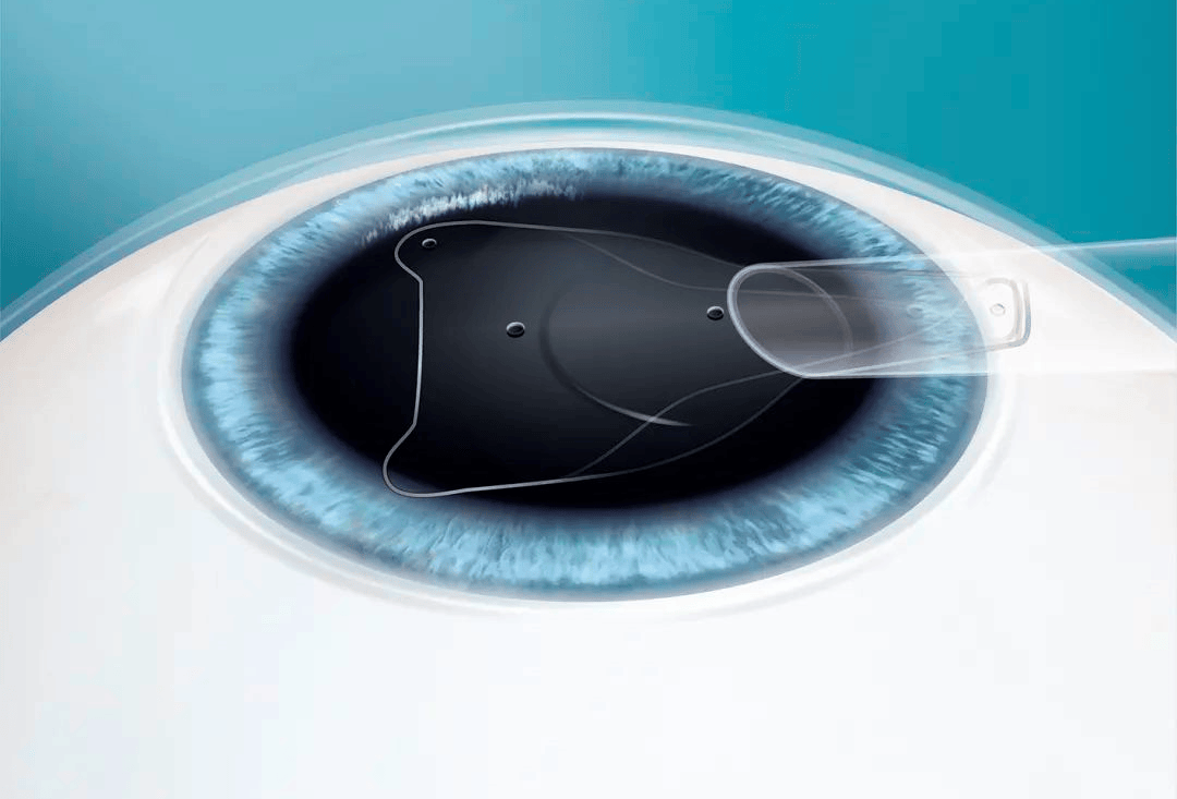 icl晶体能和眼睛和谐相处吗