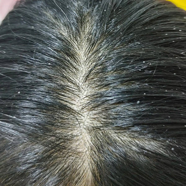 青少年头屑特别多用什么洗发水去头皮止痒的洗发水推荐