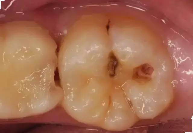 从蛀牙到拔牙,你珍惜你的牙齿了吗?_治疗_食物_病变