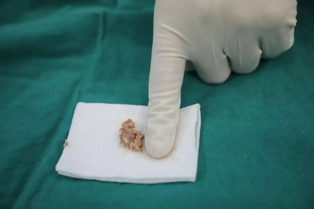 玉林一幼儿被骨头卡住食道超3天,辗转多家医院就诊……_异物_小孩子