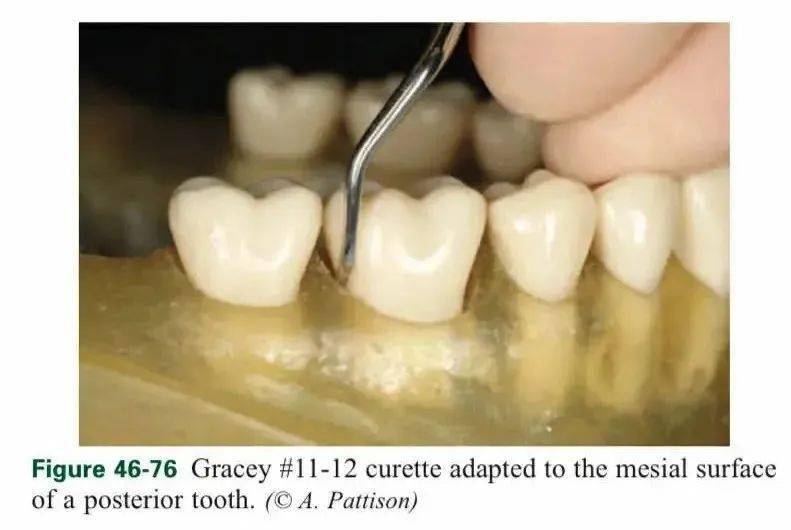 龈下刮治的目的是清除潜藏在牙龈深处的牙结石,图源:carranzas