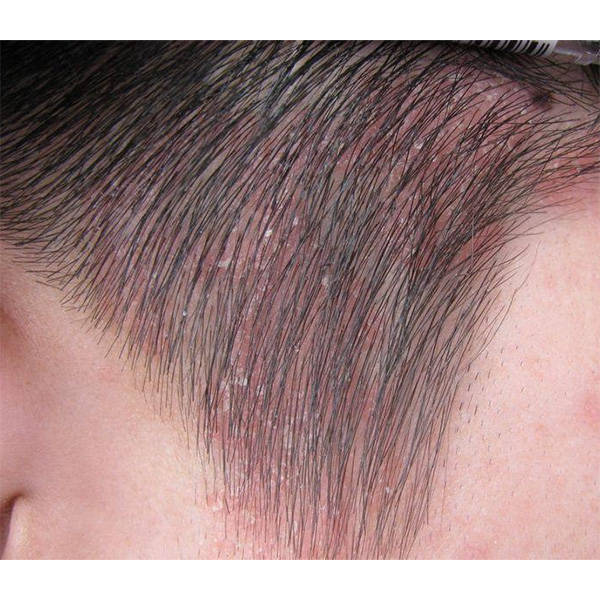 青春期男孩头屑多用什么洗发水去屑滋润的洗发水推荐