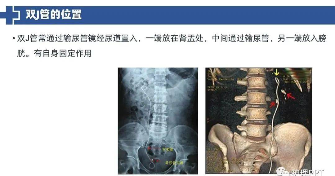 ppt双j管置入术后患者护理