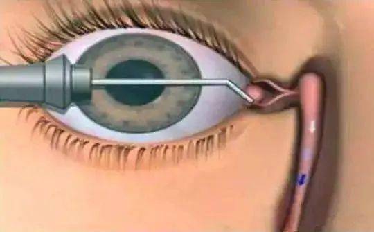 囊吻合术的患者,可显示泪囊窝骨质缺损情况,慢性泪囊炎窦道形成的患者