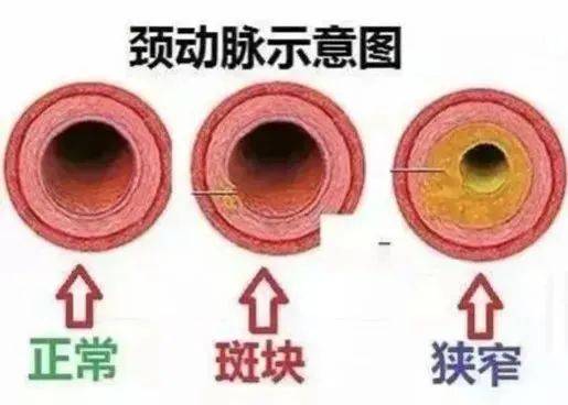 脖子里的钢丝儿管颈动脉支架