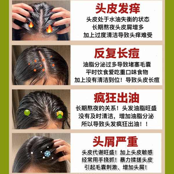 头皮问题产生原因如下:头皮屑和头痒通常是由多种因素引起的,包括脂溢