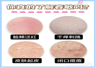 皮肤发红起疹子还刺痒春季敏感肌做好这几点才能不烂脸