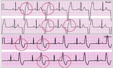 心脏早搏心电图怎么看图片