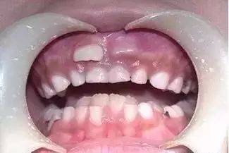 宝宝_牙齿_乳牙