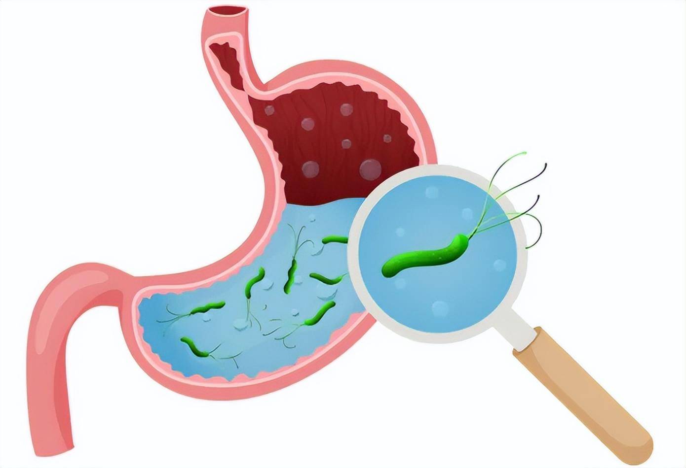 协和科普:击退幽门螺杆菌,这样做有用!