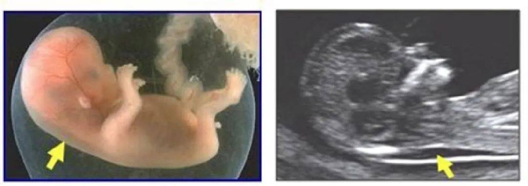 在孕14周以前,会有少量的淋巴液聚集在胎儿的颈部淋巴管内,从而形成
