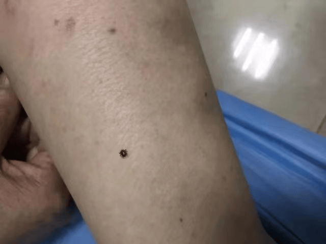 "chóng 出没",已进入活跃期,严重可致命_皮肤_部位_马蜂