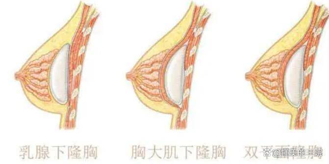 隆乳术:一项改变生活的美容手术_乳房_女性_组织