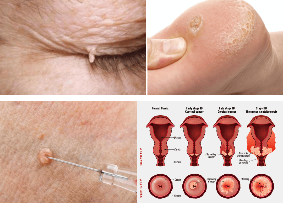 恶性疾病相关性更高的 hpv 分型,被称为高危型人乳头瘤病毒(如 hpv16