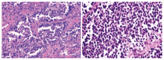 全国肿瘤防治宣传周|揭秘儿童健康隐形杀手——横纹肌肉瘤