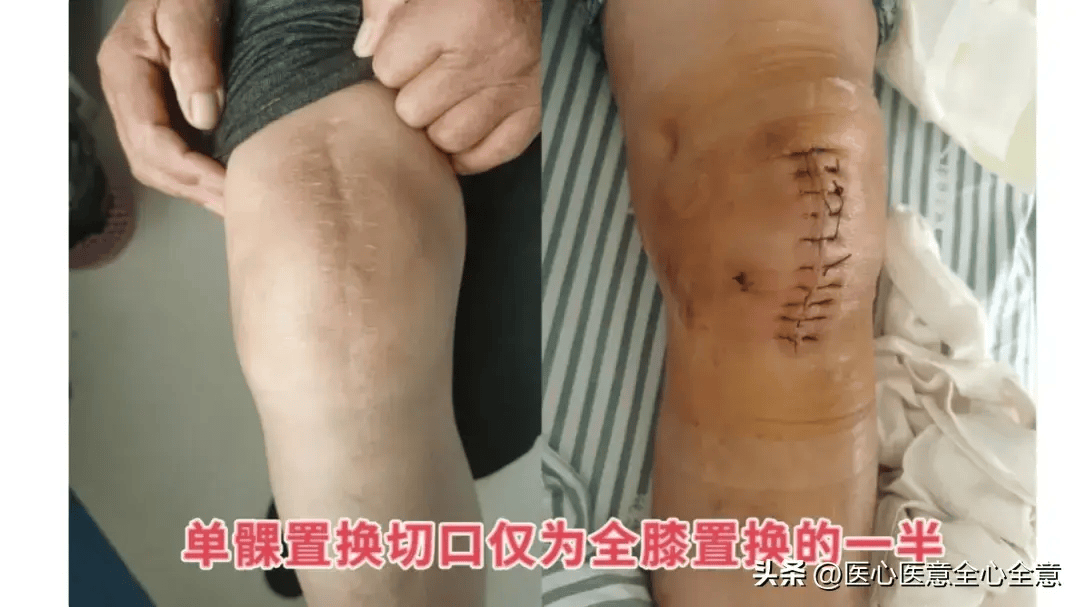 从全膝置换到单髁"智换"_周大爷_膝关节_李兵