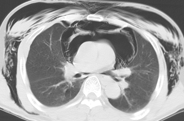 一文总结「少见的杀手」纵隔张力性气肿全貌
