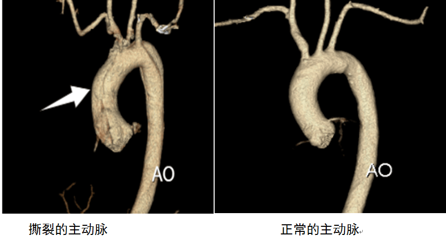 "血管炸弹"a型主动脉夹层突袭准妈妈,多学科团队成功"拆弹" "卸货"