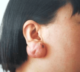 【微整形科普】整形颌面外科:什么是瘢痕,能通过手术消除吗?(上篇)