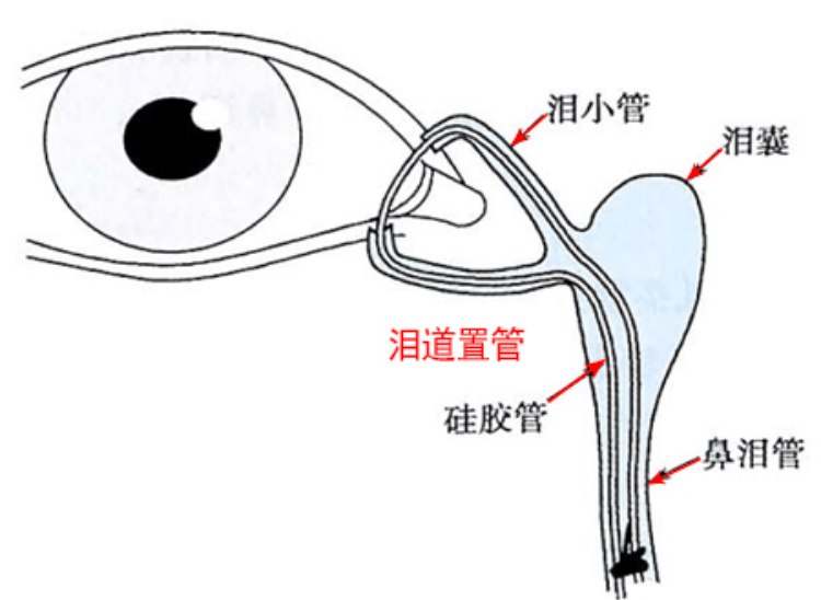 泪道_手术_鼻腔